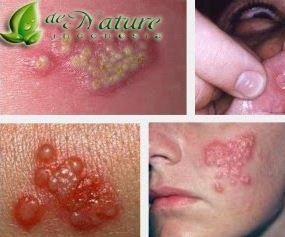 Illustration for article titled Obat Herpes Herbal
